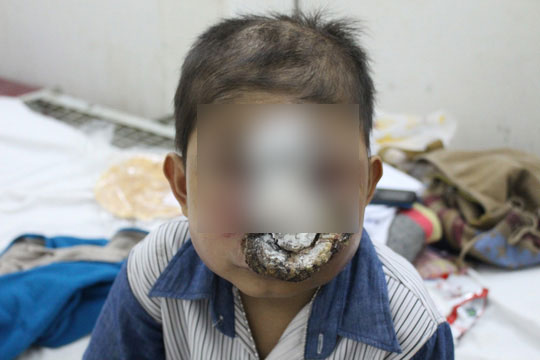 Bé trai mất mạng vì bệnh “lạ” ăn mòn khuôn mặt