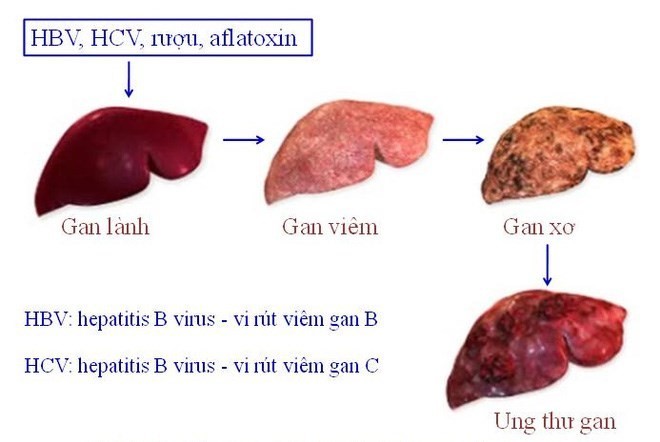 
Tiến tr&igrave;nh ung thư gan.
