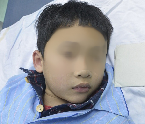 Đầu bút bi dài 1 cm nằm 4 ngày trong phế quản bé trai 7 tuổi