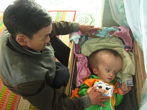 Cháu bé bị não úng thủy