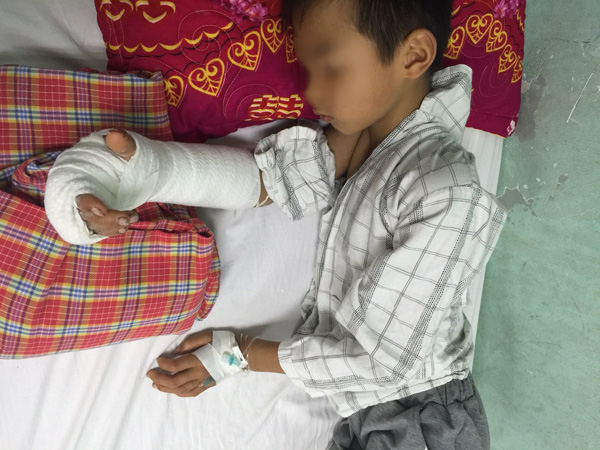 Đùa nghịch, anh họ 14 tuổi chém gần đứt lìa tay em trai