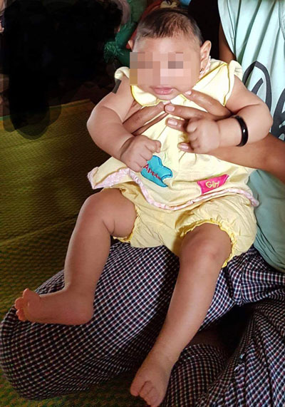 Một bé gái bị đầu nhỏ nghi do Zika