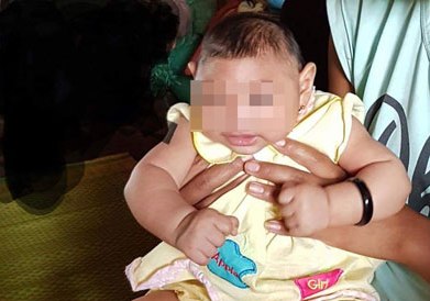 Bé gái 4 tháng tuổi ở Đắk Lắk bị dị tật do virus Zika