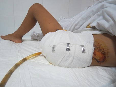 Tình tiết bất ngờ vụ nhân viên y tế tự cắt chân mình