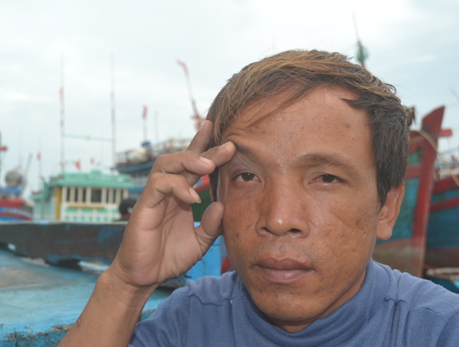 Một ngư d&acirc;n bị ph&iacute;a Trung Quốc đ&aacute;nh bầm mắt