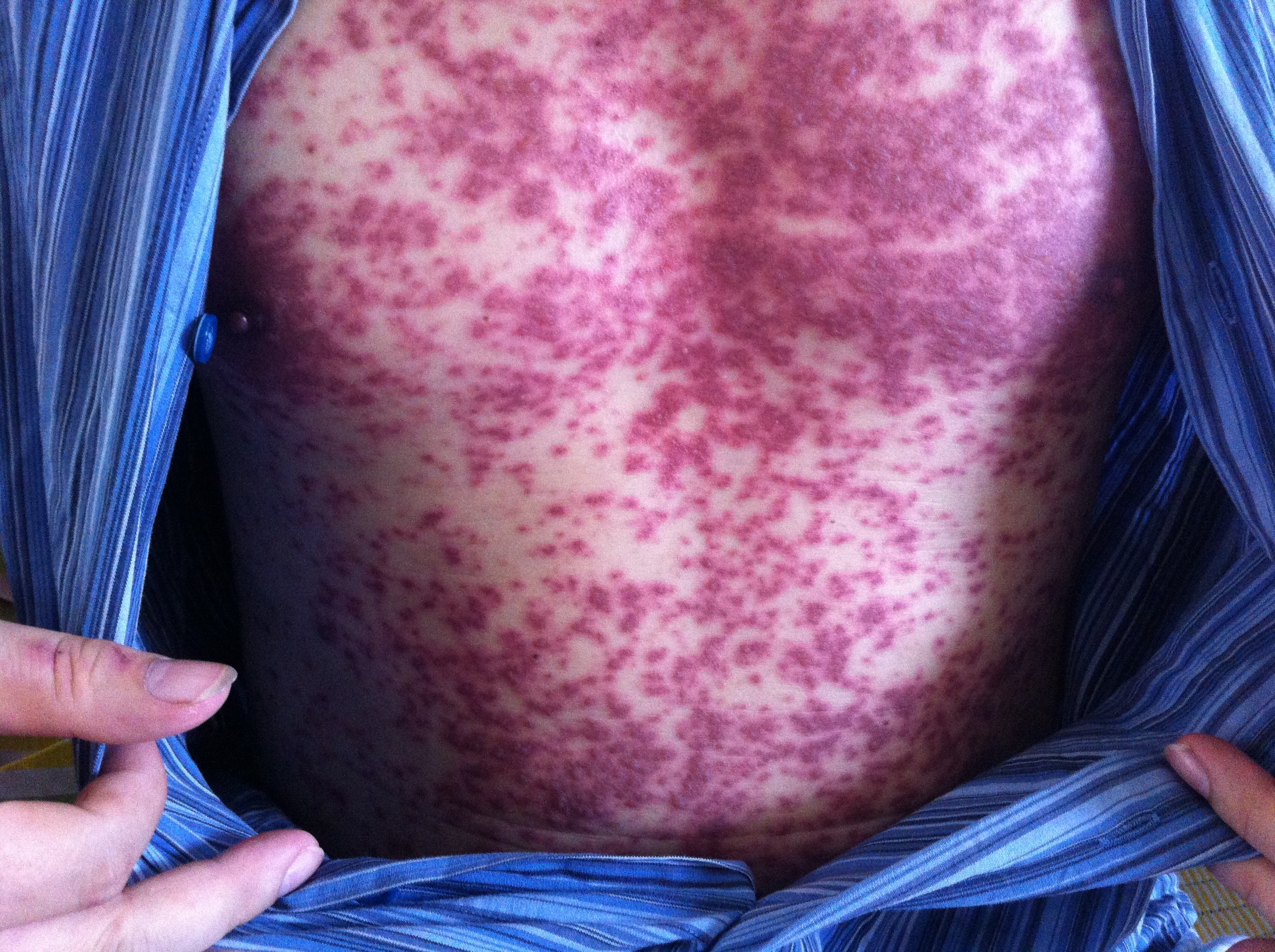 Uống thuốc trị bệnh gút, loét bộ phận sinh dục