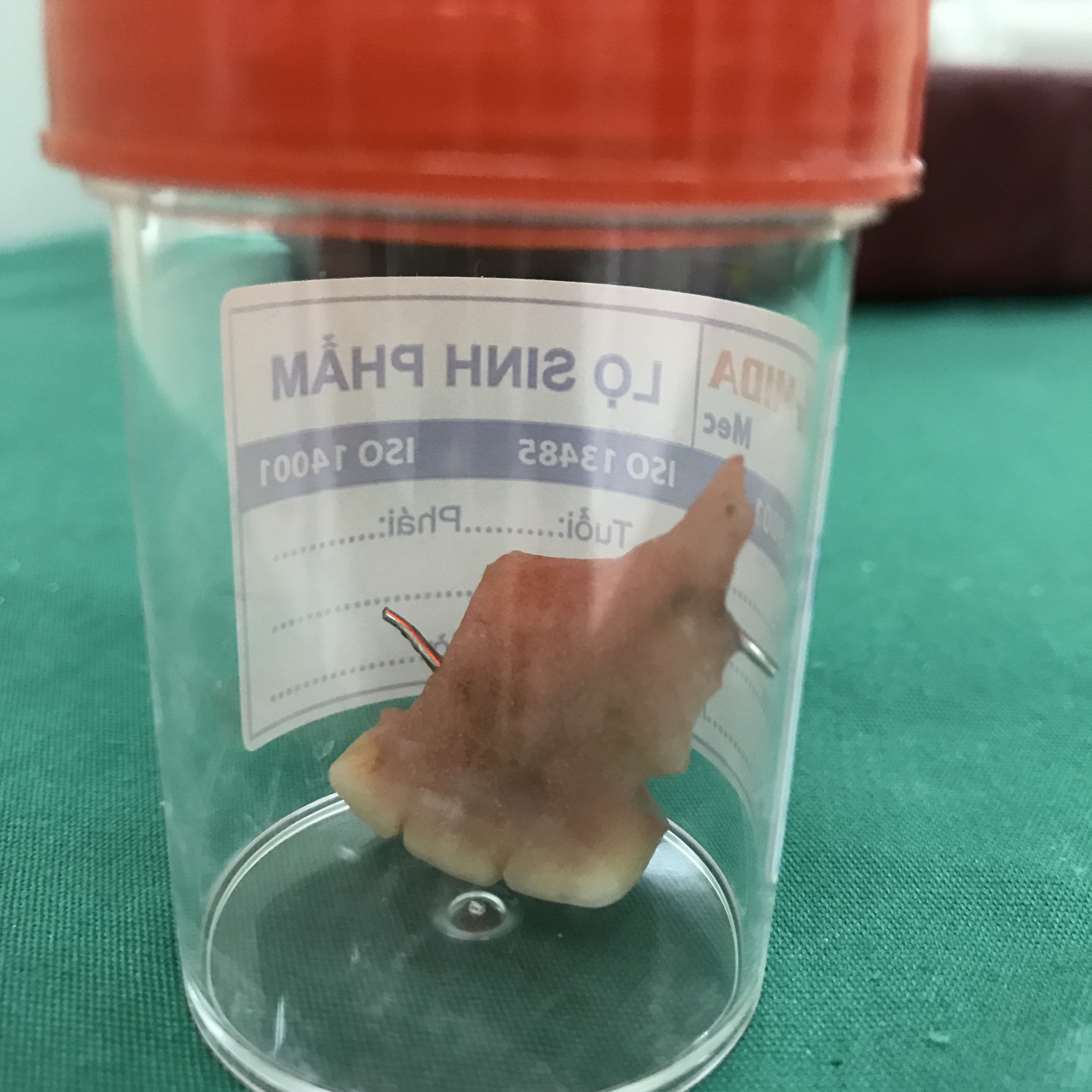 Dự tiệc về nghỉ trưa, nam thanh niên nuốt luôn răng giả
