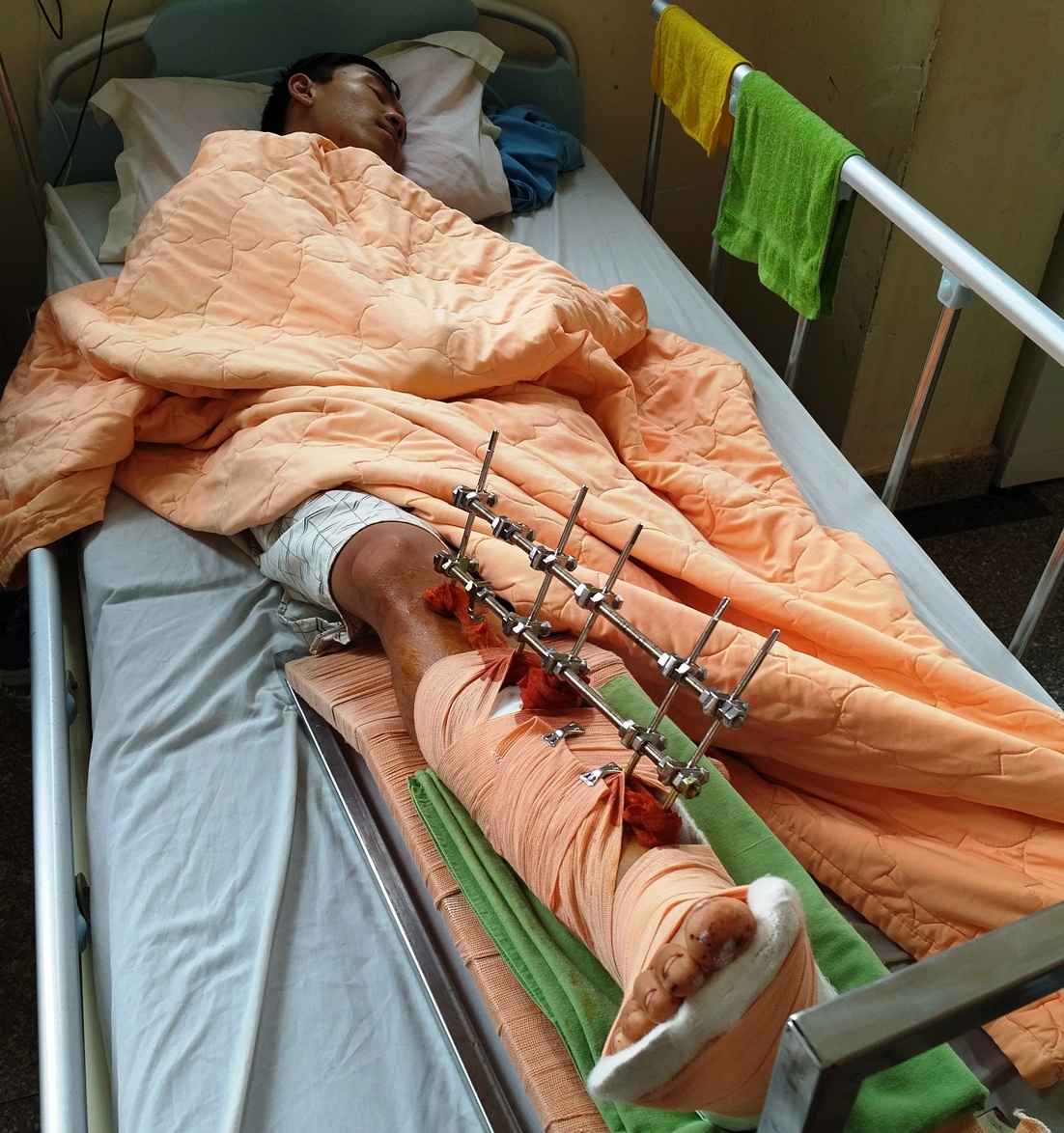 Nam thanh niên bị chém đứt lìa chân ở Gia Lai