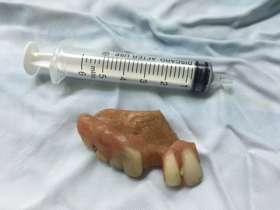 Nhập viện vì ăn bún nuốt hàm răng giả vào thực quản