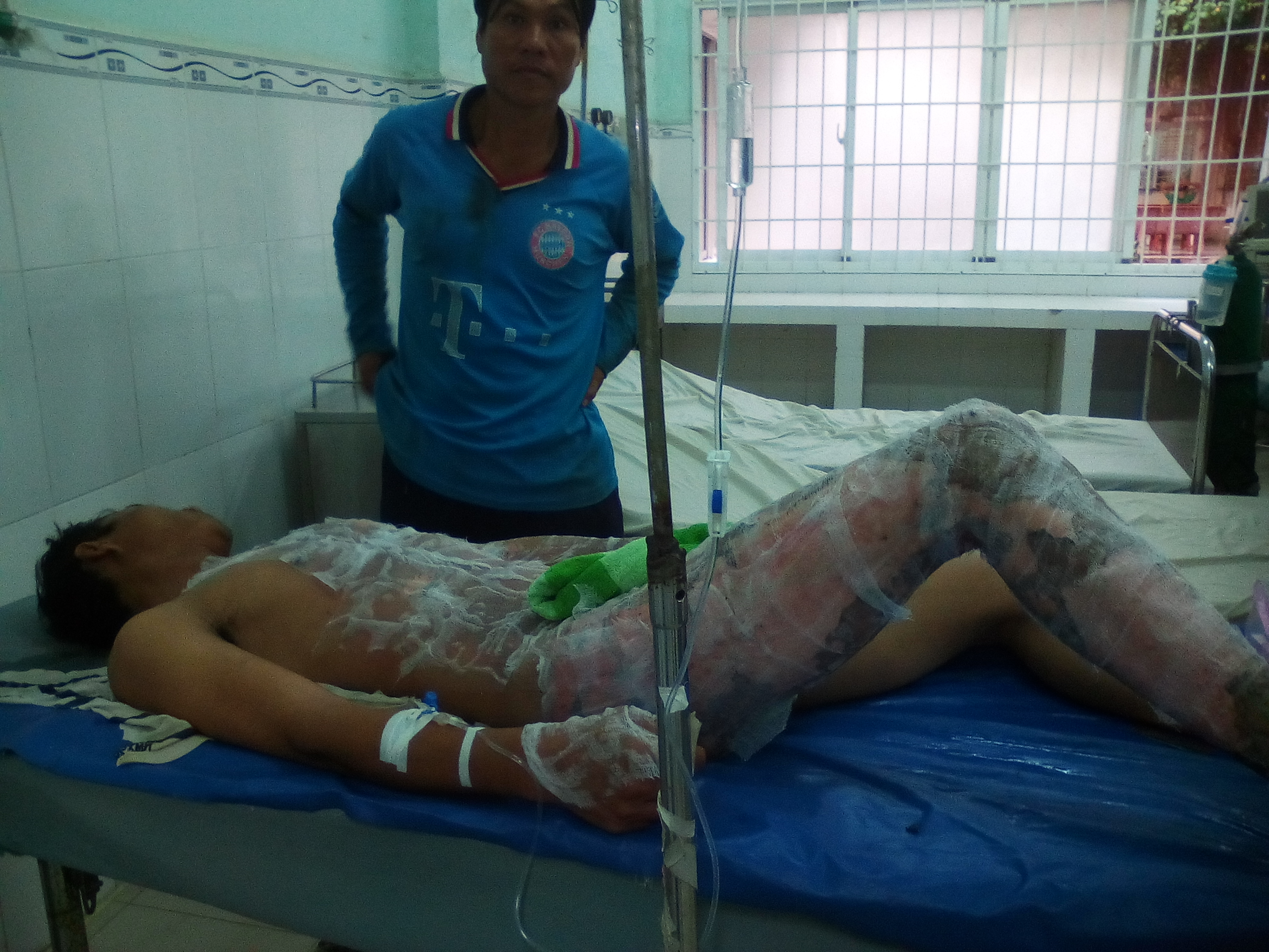 Hy hữu thợ điện thoát chết dù bị điện giật, bỏng nặng