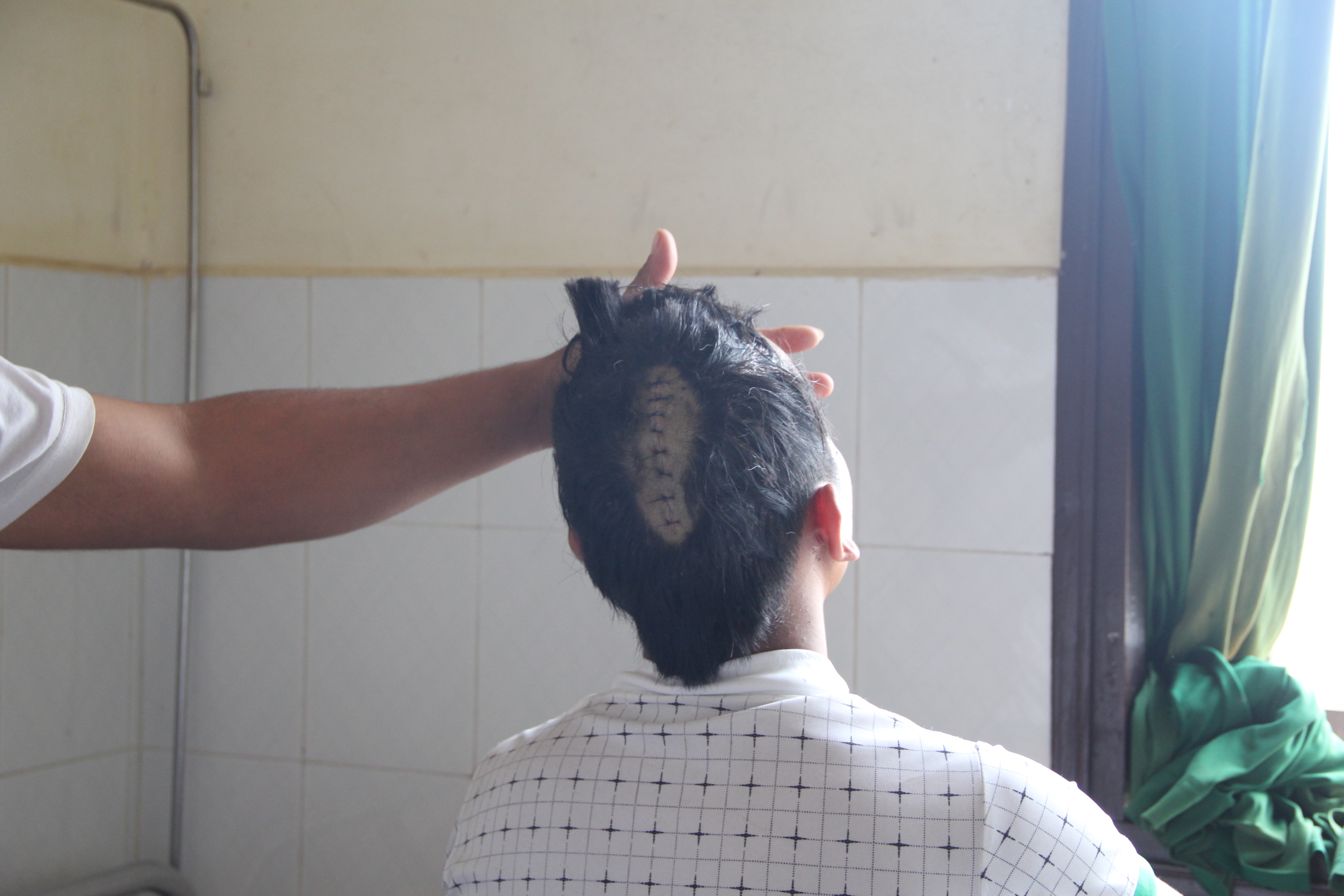 K Đích bị chém nứt sọ và gãy 2 ngón tay trái đang điều trị tại Bệnh viện Đa Khoa II Bảo Lộc (Lâm Đồng).