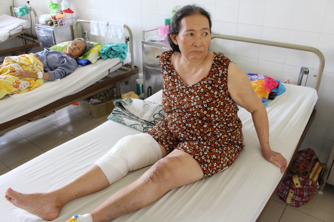 Thay khớp gối thành công bằng... xi măng