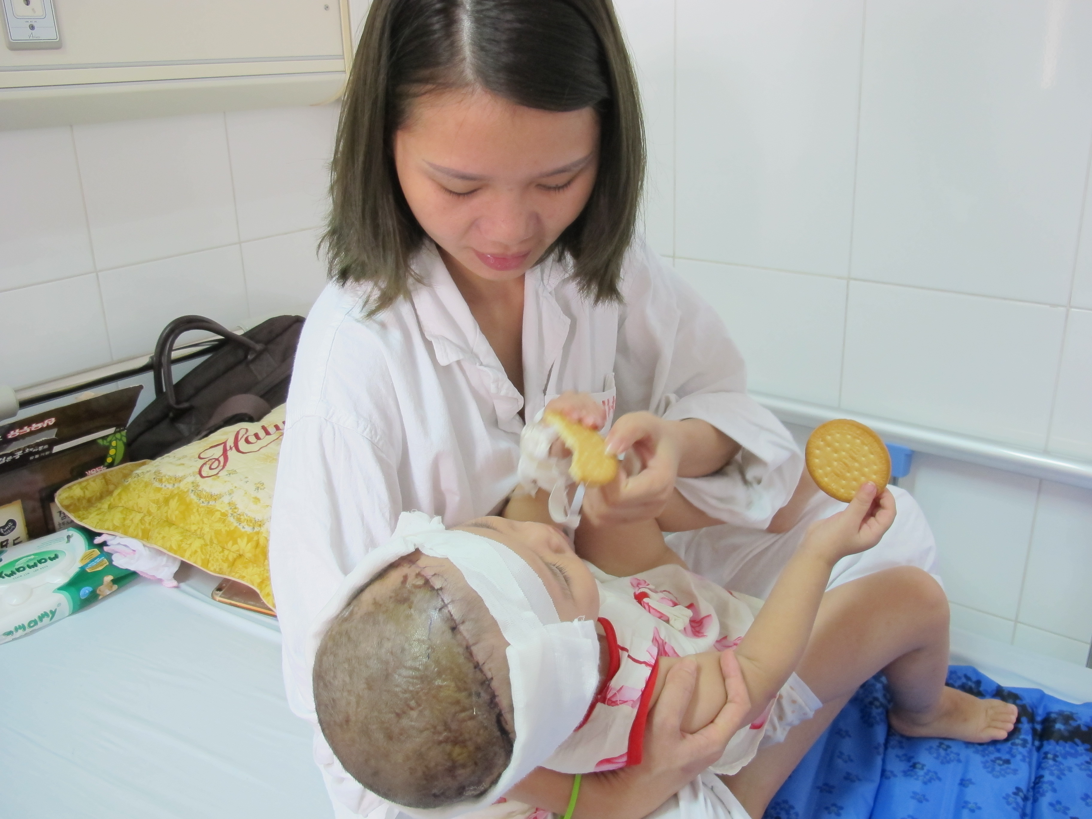 Bé gái 2 tuổi bị lột toàn bộ da đầu vì tai nạn giao thông