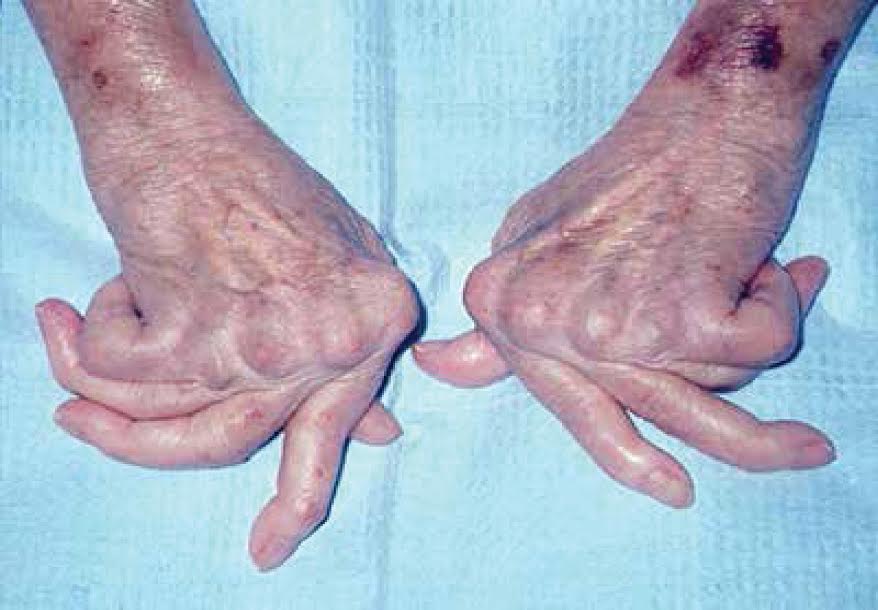 Ho ra máu vì uống thuốc "truyền tai"