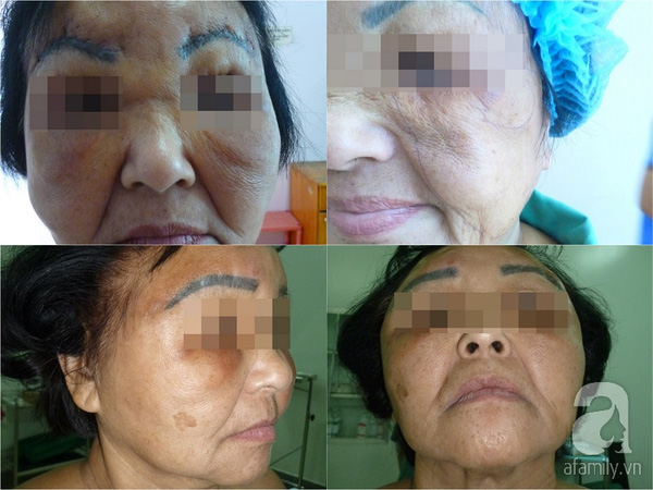 Bơm silicon lỏng nỗi hối hận muộn màng