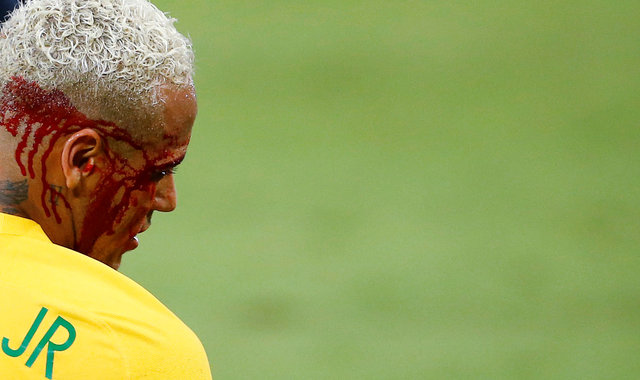 Brazil thắng đậm nhưng Neymar đổ máu