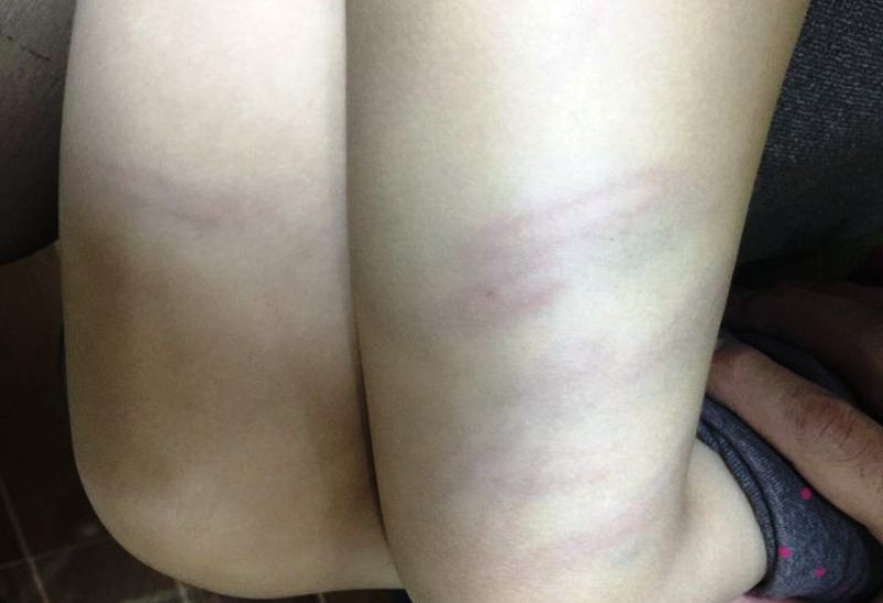 Sa thải giáo viên mầm non đánh trẻ thâm đùi
