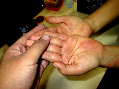 Coi chừng phát ban, nổi mẩn… đánh lừa