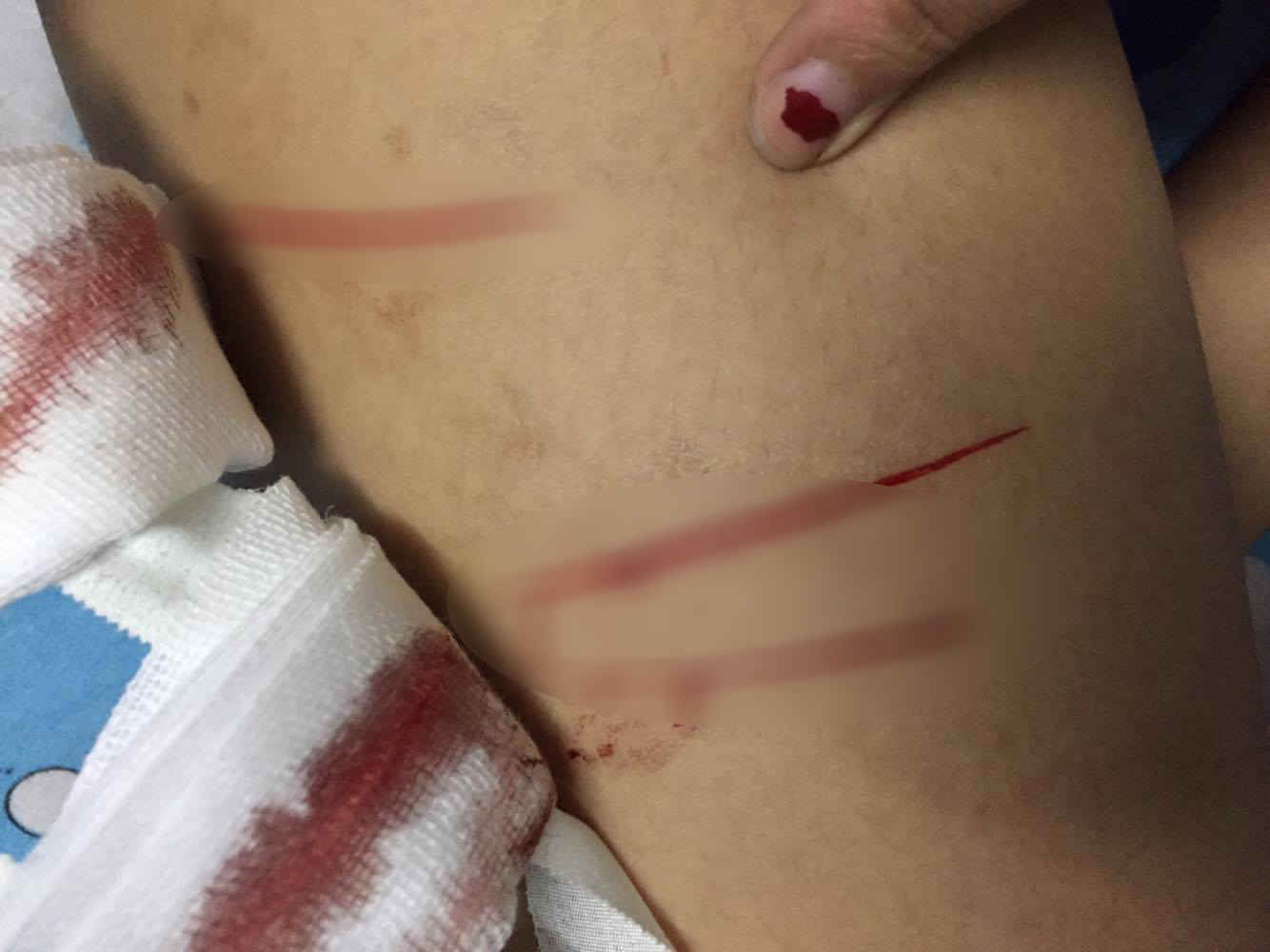 Hiện tại vết thương vẫn kh&aacute; s&acirc;u v&agrave; nghi&ecirc;m trọng khiến nữ sinh 19 tuổi trong t&igrave;nh trạng sốt nhẹ v&agrave; mệt mỏi.