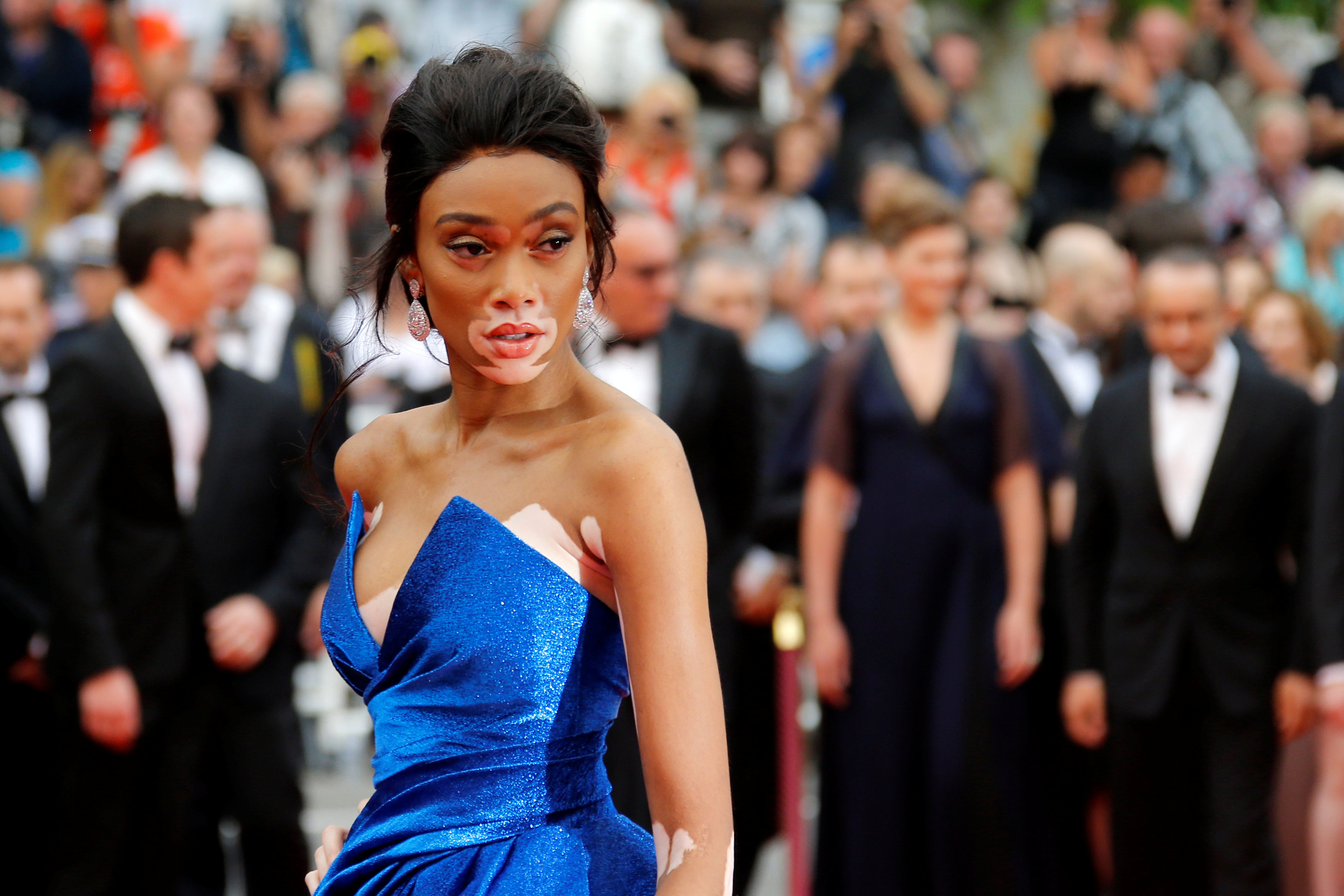 Người mẫu bạch biến tự tin khoe dáng tại Cannes 70