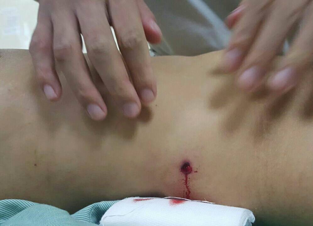Đi trên phố, người phụ nữ bị đạn lạc thủng bụng