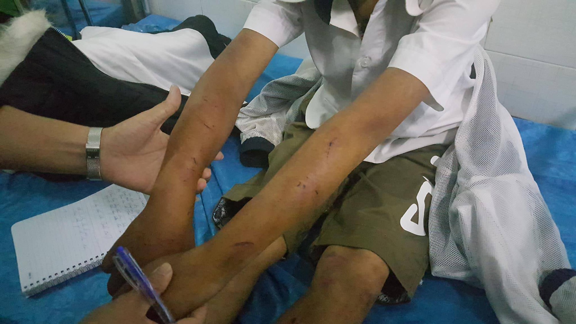 Một học sinh lớp 6 bị cha đẻ đánh bầm dập