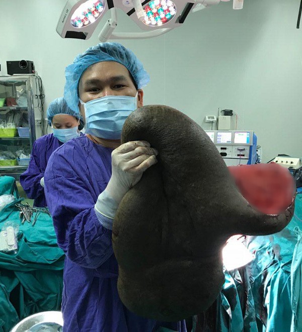 Kinh h&atilde;i với tấm mai r&ugrave;a lớn cắt ra từ lưng người thanh ni&ecirc;n - Ảnh 4.