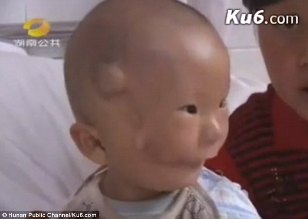 Sau khi được phẫu thuật, tình trạng của bé Khang Khang đã khá hơn. Ảnh: Hunan Public Channel