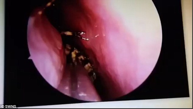 
H&igrave;nh ảnh ghi lại từ cuộc phẫu thuật loại bỏ con gi&aacute;n trong đầu b&agrave; Selvi. Ảnh: SWNS
