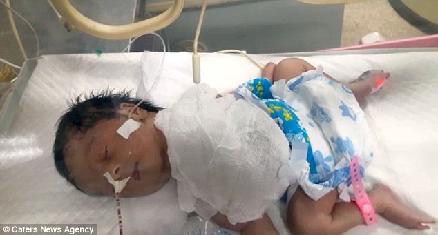 Mắc bệnh lạ, em bé sơ sinh có tim nằm ngoài lồng ngực