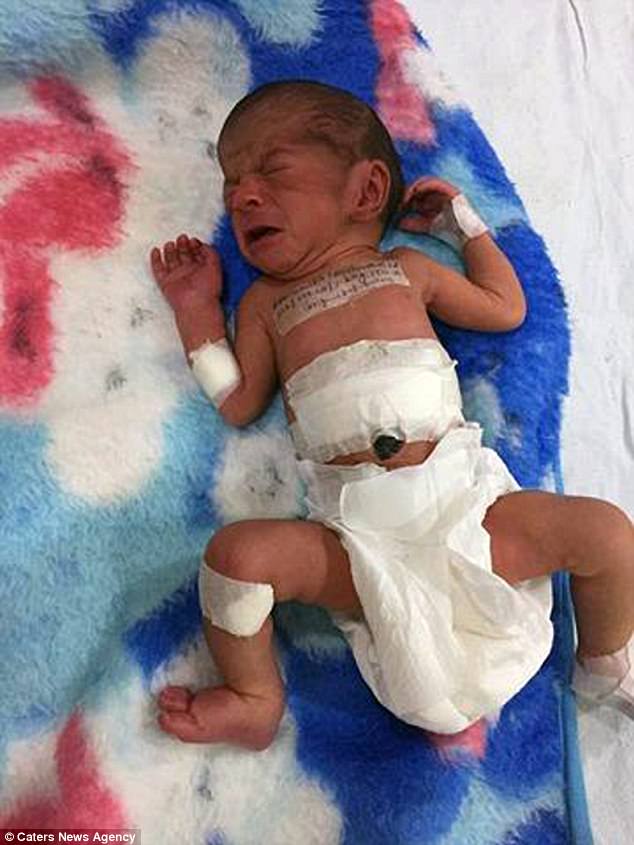 Ch&aacute;u b&eacute; được phẫu thuật th&agrave;nh c&ocirc;ng v&agrave;o ng&agrave;y 26-4 vừa qua - ảnh DAILY MAIL