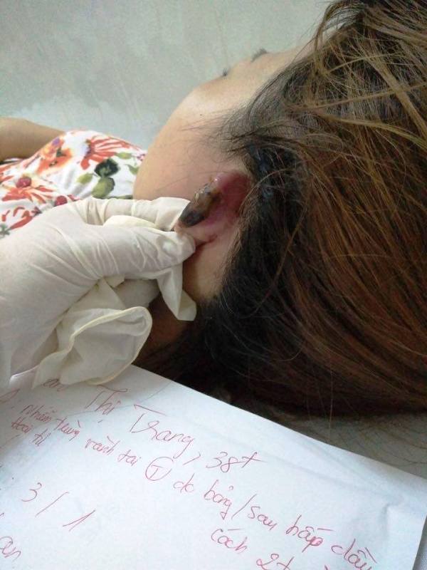 Bệnh nhân bị hoại tử vành tai, phải cắt bỏ.