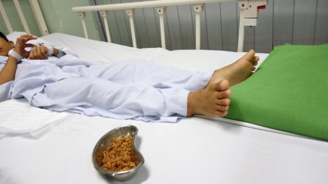 Lấy hơn 70 gram hạt sơ-ri nảy mầm trong hậu môn bé trai