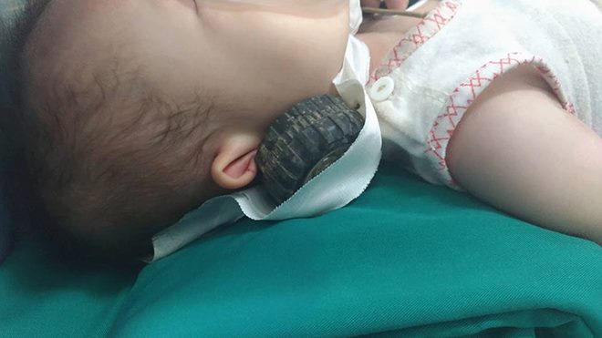 Bé 11 tháng bị trục sắt bánh xe đồ chơi dài 7 cm cắm vào đầu