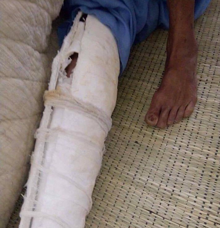 Con trai đ&aacute;nh bố đẻ g&atilde;y xương sườn, mẻ xương b&aacute;nh ch&egrave;, xương ống ch&acirc;n - Ảnh 2.