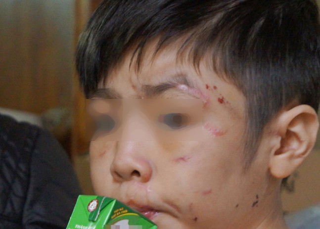 Bác sĩ tâm lý "mổ xẻ" vụ bố, mẹ kế bạo hành bé trai 10 tuổi