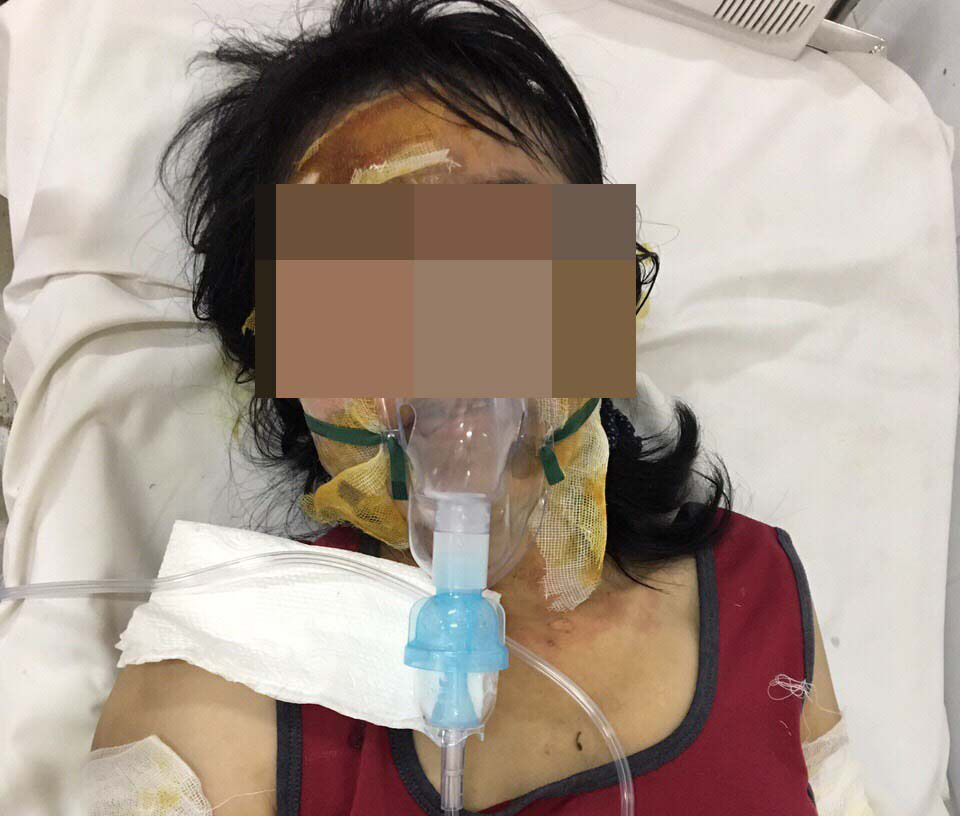 Cô giáo bị bỏng nặng ở Phú Quốc đang dần hồi phục