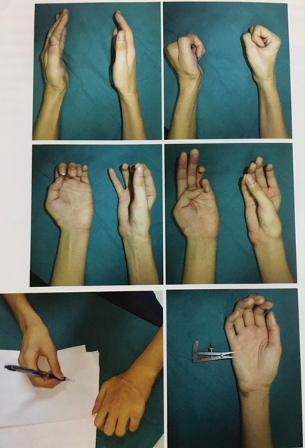 Hai b&agrave;n tay đứt rời ho&agrave;n to&agrave;n phục hồi kỳ diệu sau gh&eacute;p nối - Ảnh 3.