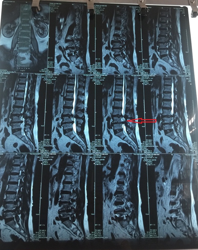 Bơm xi măng vào cột sống cứu cụ bà bại liệt