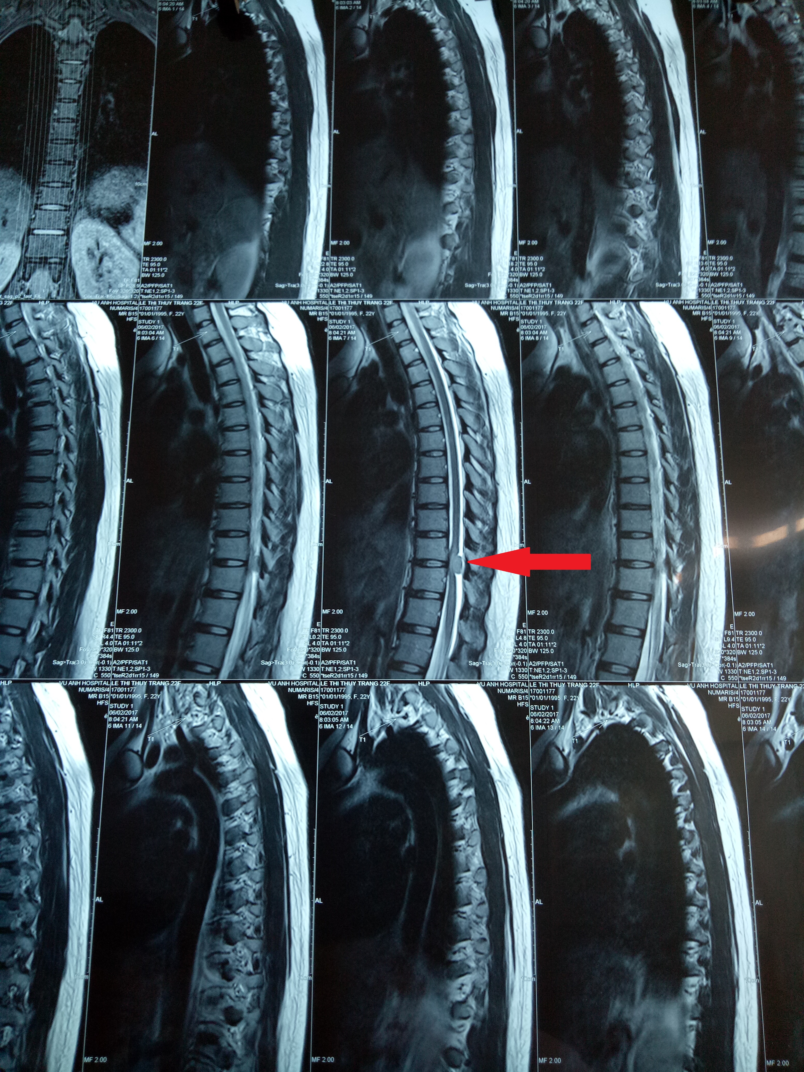 Tỉ mẩn lấy u tủy sống cứu cô gái trẻ khỏi bại liệt