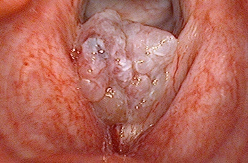 Nhiễm virus HPV, sinh vi&ecirc;n 23 năm mang ống th&ocirc;ng ngay cổ - Ảnh 1.