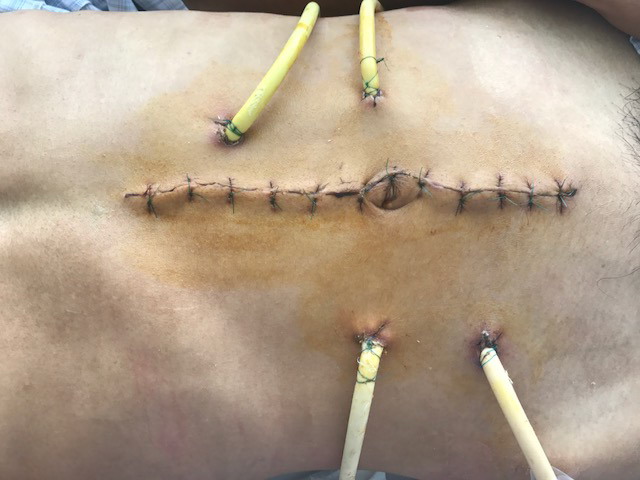 Suýt chết do bị cọc bê tông thúc vào bụng