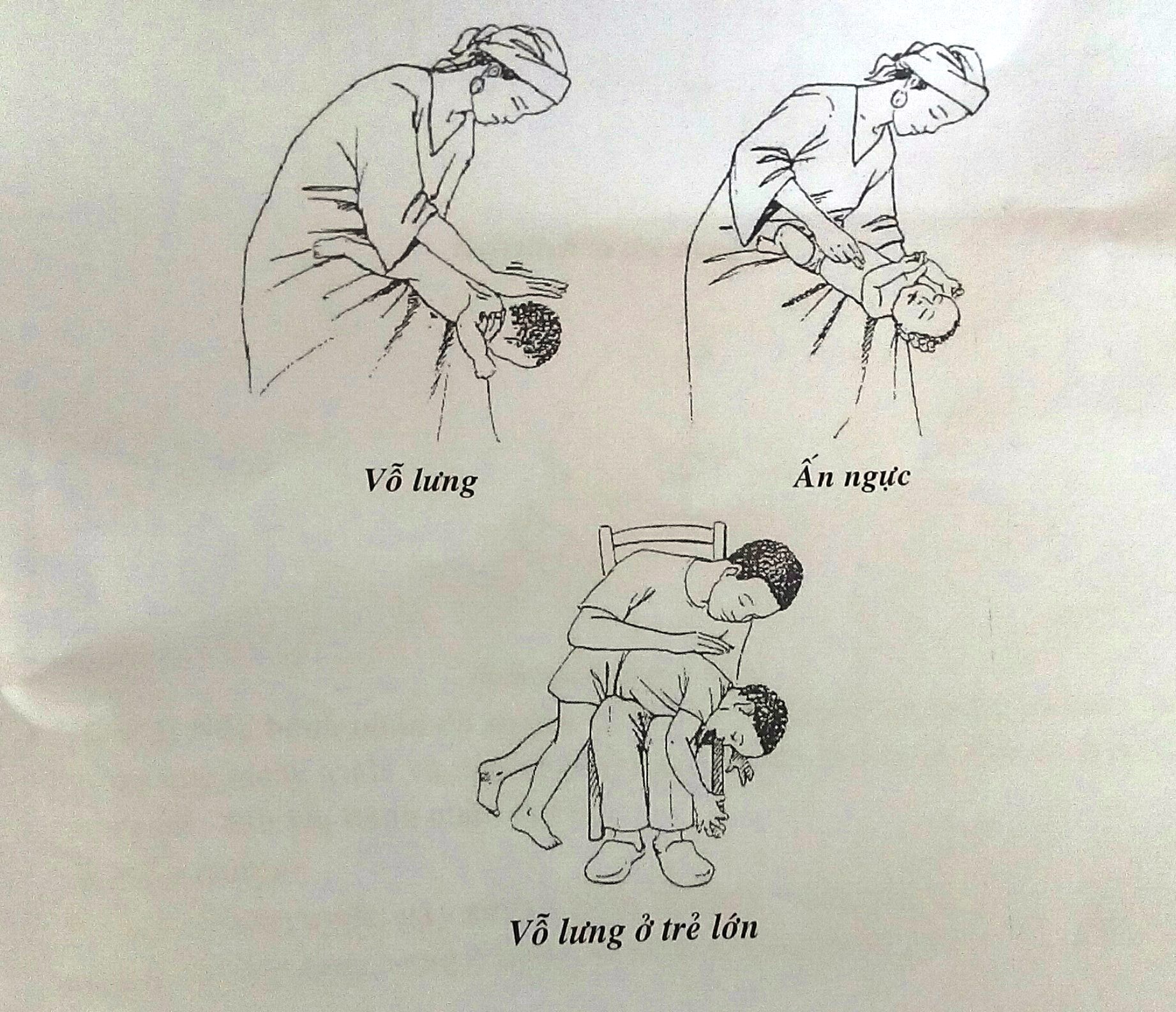 Cách vỗ lưng, ấn ngực để tống dị vật ra ngoài - ẢNH DO BỆNH VIỆN NHI ĐỒNG 1 CUNG CẤP