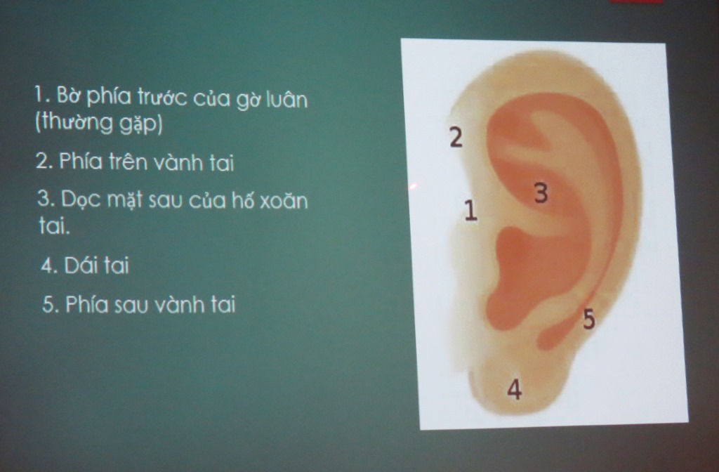 Bỏ qu&ecirc;n đoạn tăm nhang trong tai suốt 1 năm - Ảnh 3.