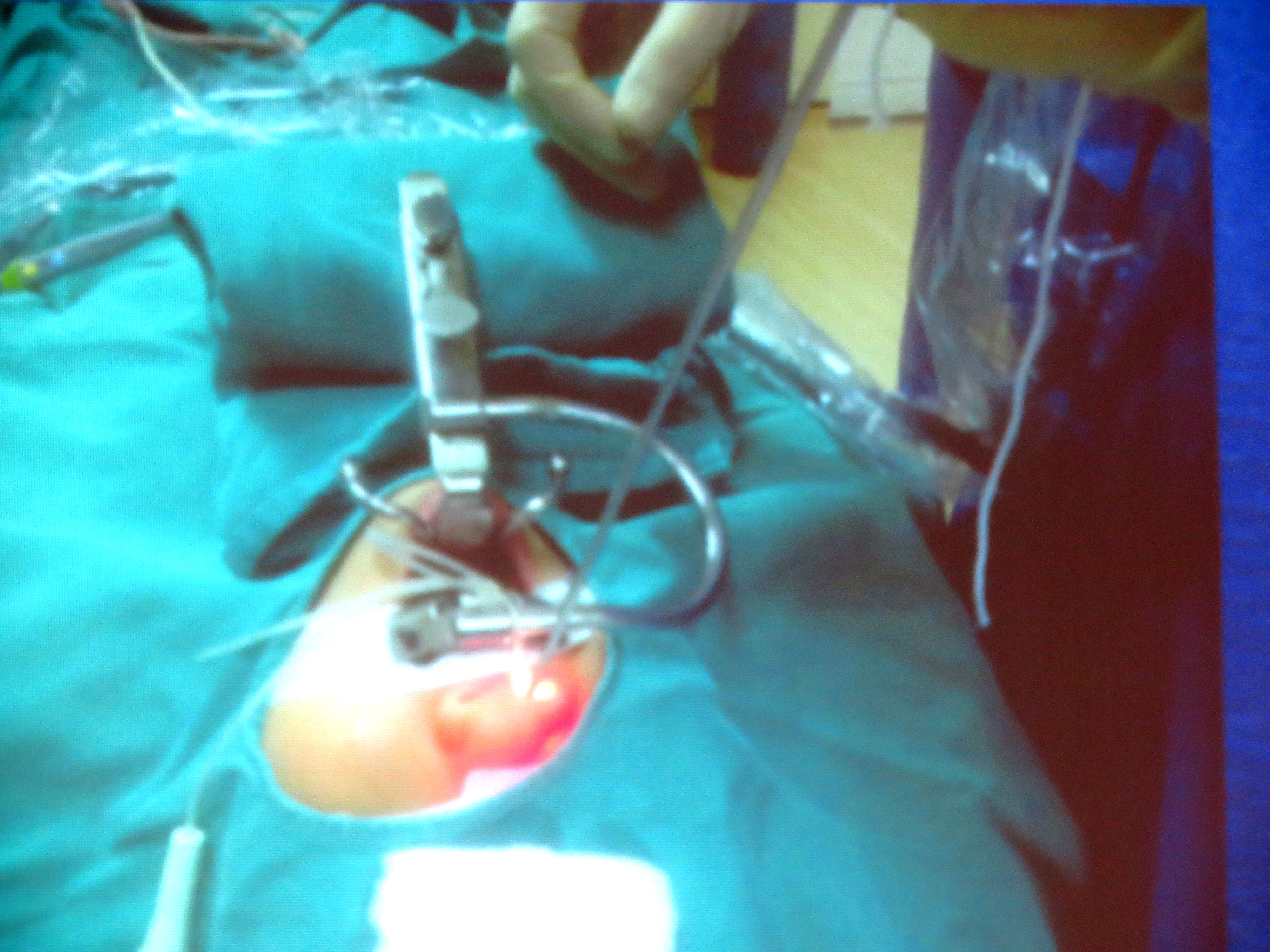 Dao plasma giúp phẫu thuật tai mũi họng không đau đớn