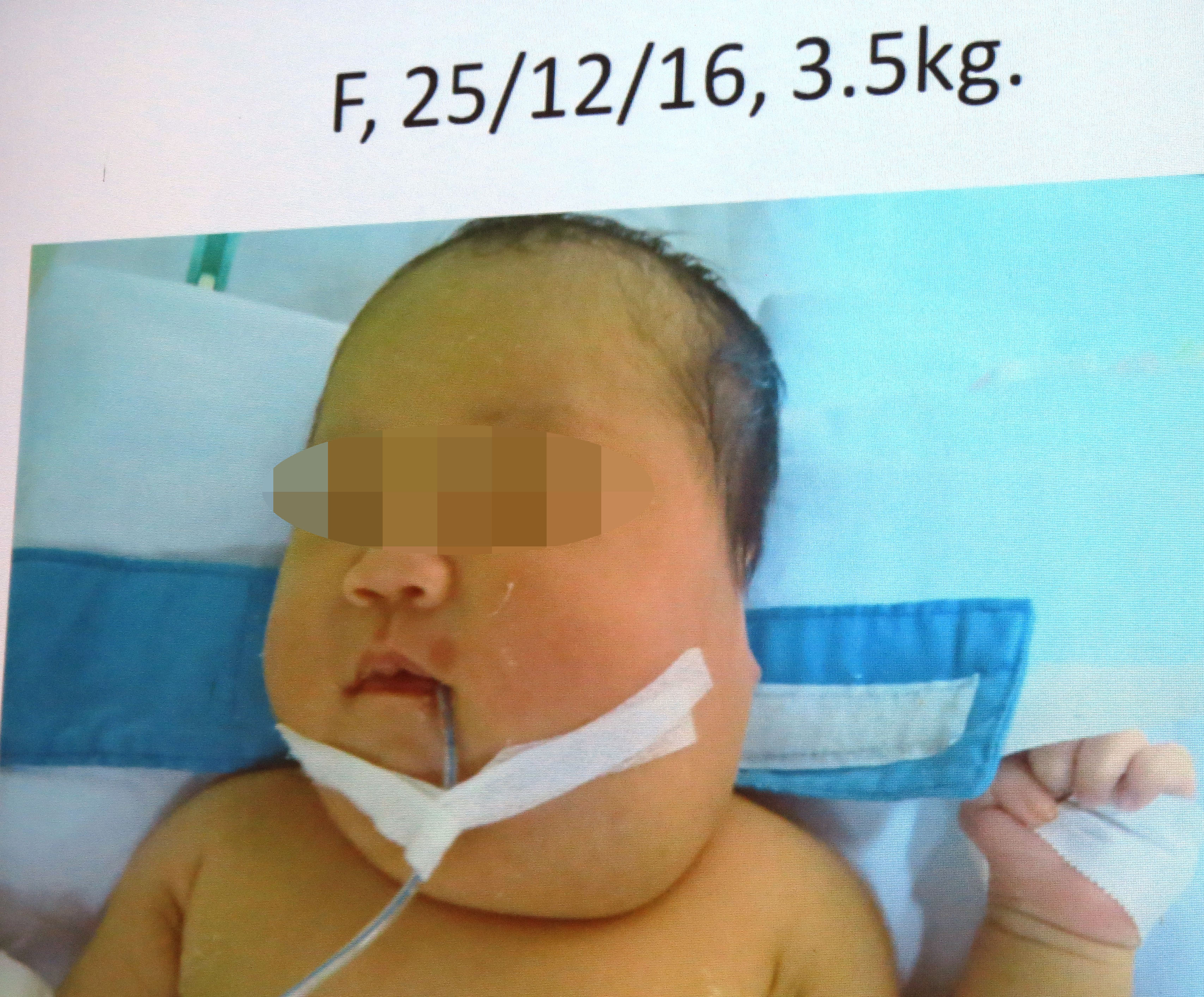 Loại bỏ bướu quái chứa xương, tóc, cứu sống bé sơ sinh