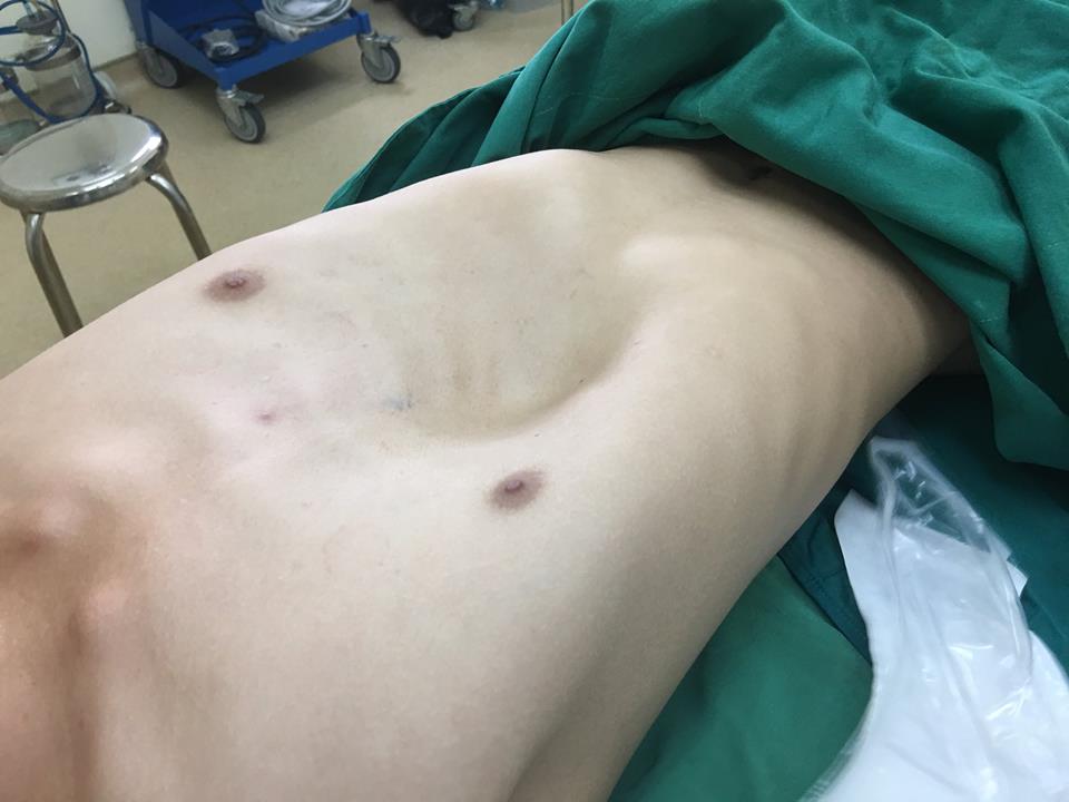 N&acirc;ng ngực cho... ch&agrave;ng trai tuổi 18 - Ảnh 1.