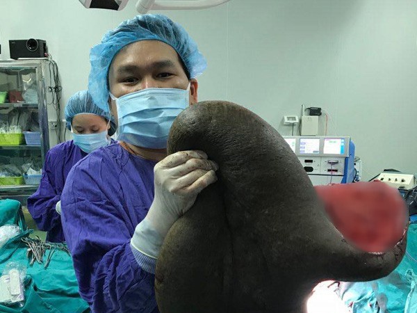 Kinh hãi với tấm "mai rùa" lớn cắt ra từ lưng người thanh niên