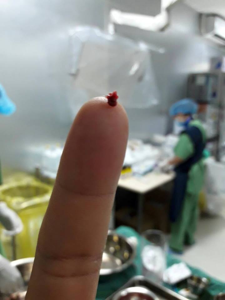 Cứu sống ca bệnh đột quỵ thập tử nhất sinh trên bàn mổ - Ảnh 2.