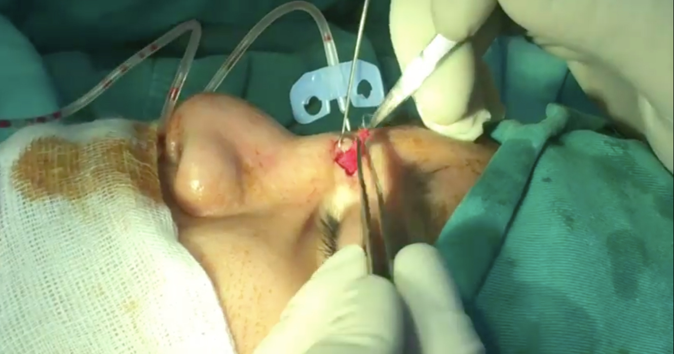 Đi nâng mũi, cô gái bị bỏ quên gạc 2 năm